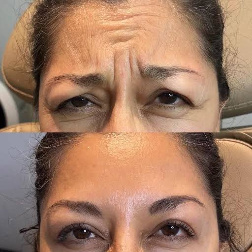 Fillers & Botox Treatments