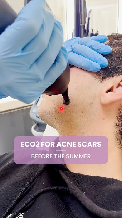 Acne Scars Treatment