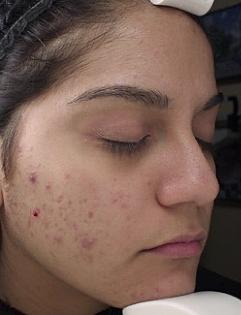 Complementary Aesthetic Procedures - Before