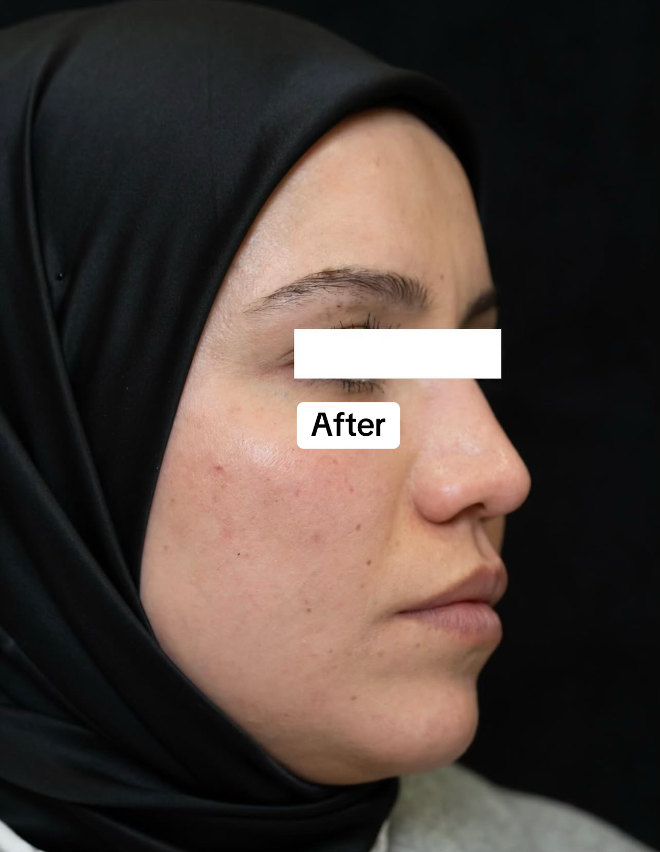 Pigmentation Treatment - After
