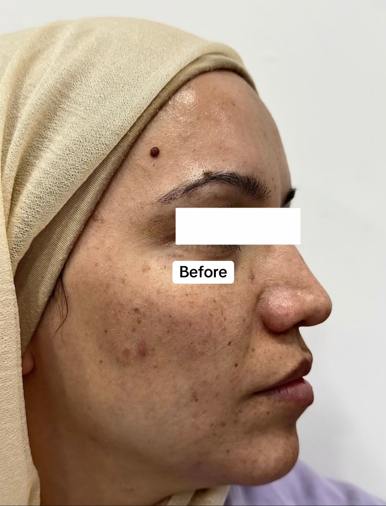 Pigmentation Treatment - Before