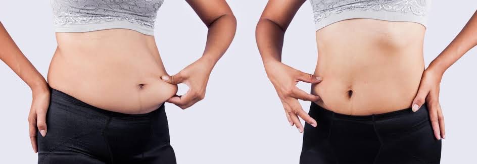 Body Excess Fat Removal & Body Contouring