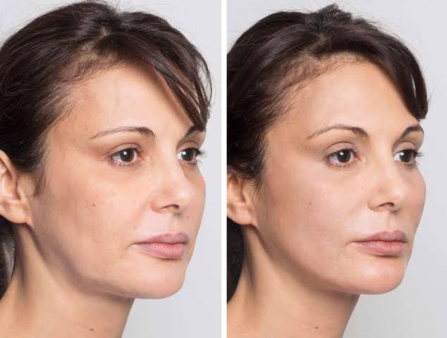 Non-Surgical Face Lifting & Rejuvenation
