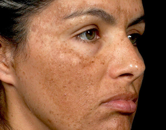 Laser Procedure