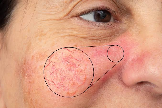American Vascular Laser